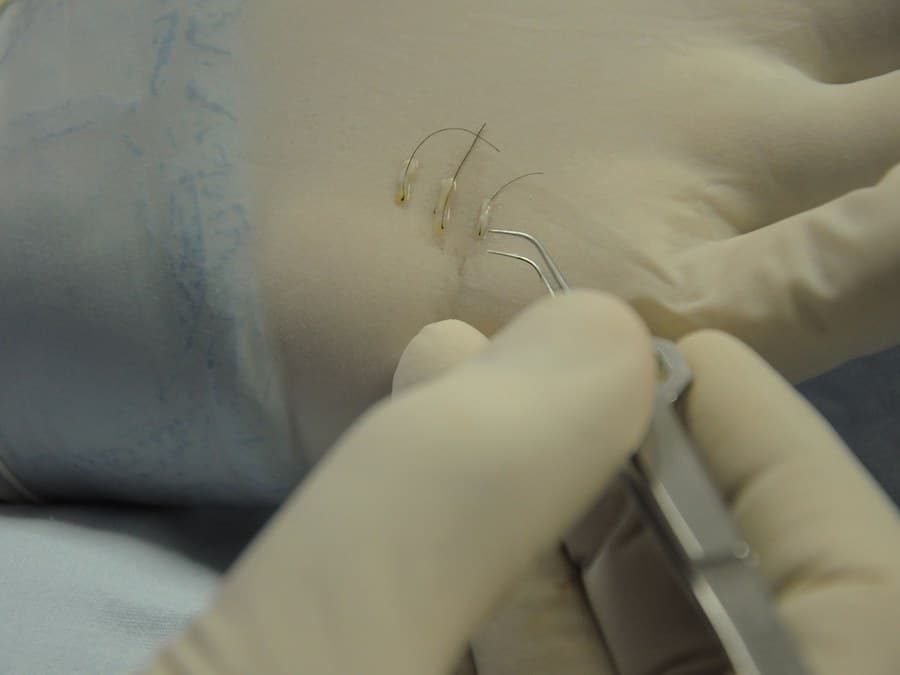 Hair transplant surgery, forceps placing a hair graft