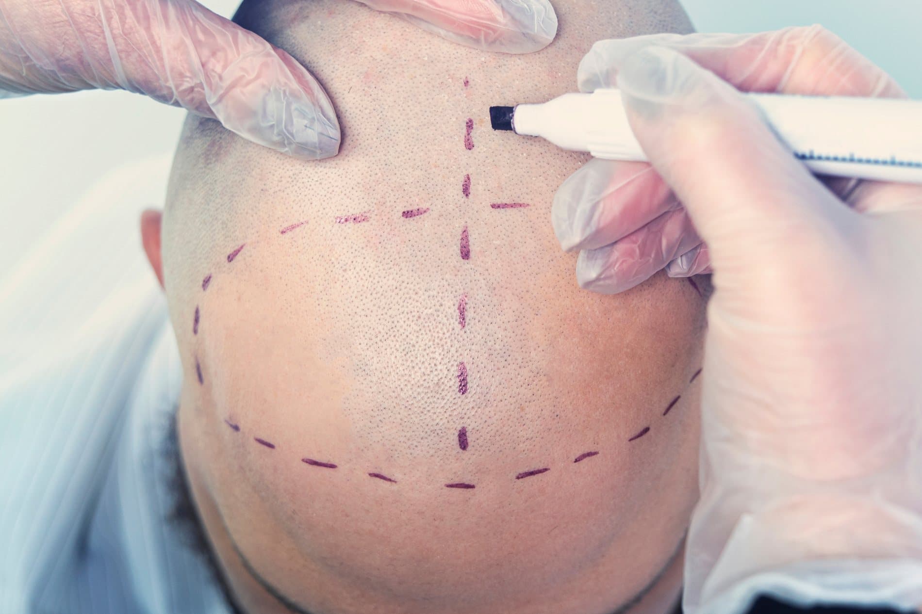 Surgeon marking a new hairline design on a patient's scalp before a transplant procedure