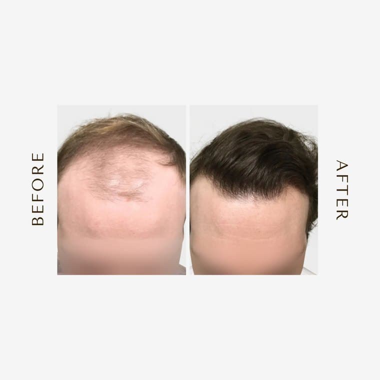 HHI patient before and after result