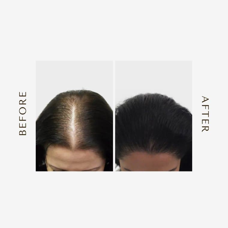 HHI patient before and after result