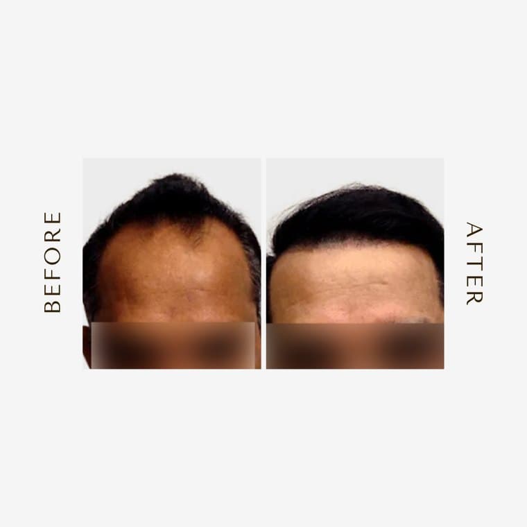 HHI patient before and after result